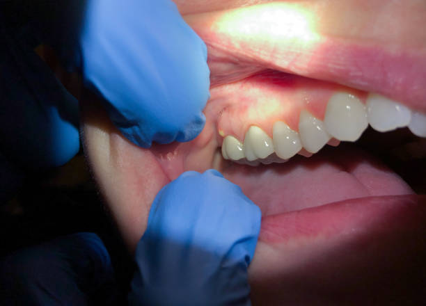 Best Emergency Dental Care for Broken or Chipped Teeth in Everman, TX