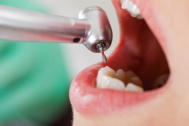 Best Emergency Treatment for Dental Infections or Abscesses in Everman, TX